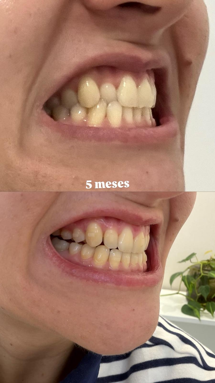 Antes e depois em 5 meses de tratamento com alinhadores
